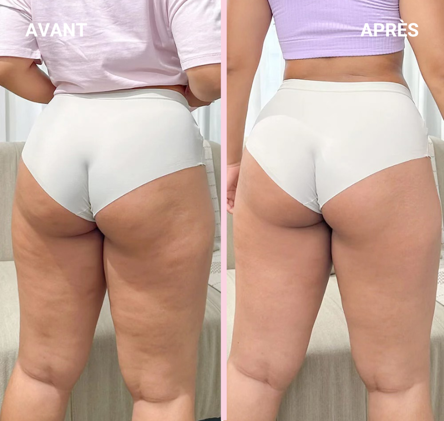 Pack Lexasculpt - Votre solution contre la cellulite